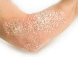 psoriasis