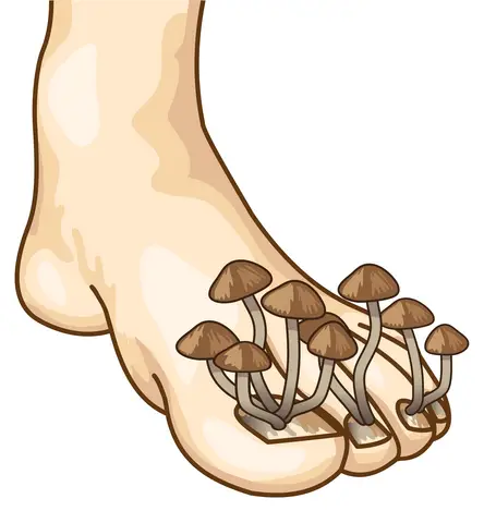 Schimmelnagels, een vervelende en hardnekkige kwaal
